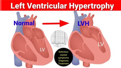 lv hypertrophy symptoms|left ventricular hypertrophy now present.